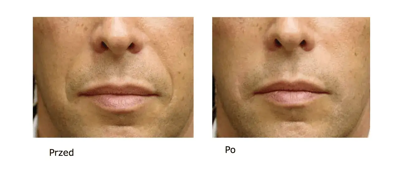 Kwas hialuronowy: Czy rozciąga skórę? Obalamy mit, rozwiewamy obawy