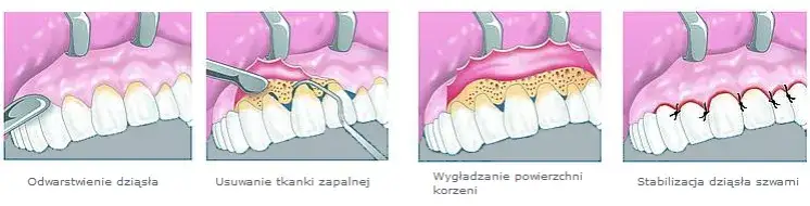 Ile trwa zdjęcie szwów z dziąsła? Szybki i bezbolesny proces