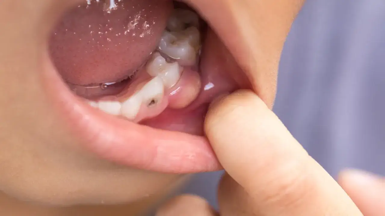 Widoczny ropień zęba, który powoduje opuchliznę policzka. Widoczny jest obrzęk dziąsła przy zębie.