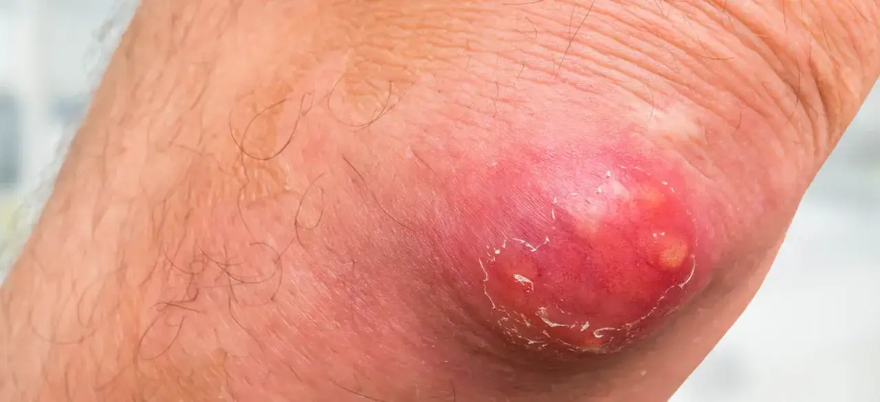 Czyrak dermatolog czy chirurg - kiedy konieczna jest operacja?