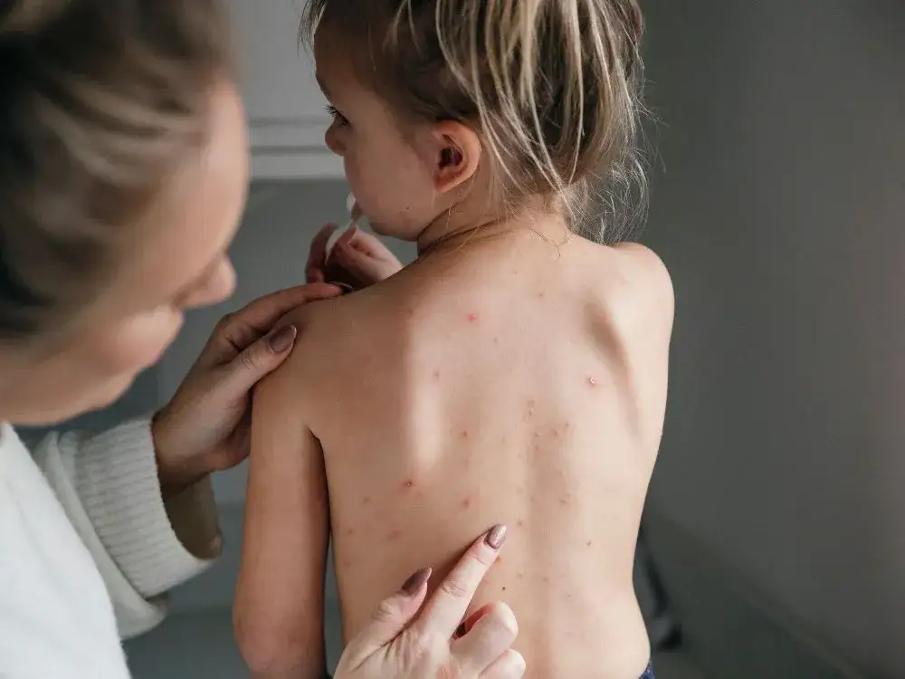 Co na ospę u dziecka - skuteczne metody łagodzenia objawów