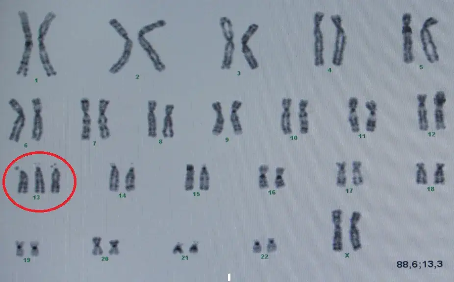 Ile chromosomów ma człowiek z autyzmem? Zaskakujące fakty genetyczne