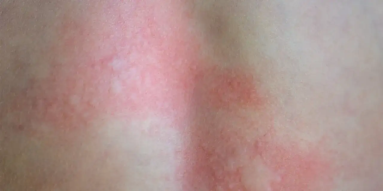 Rumień po kleszczu: Kiedy się pojawia? Jak rozpoznać i co robić?