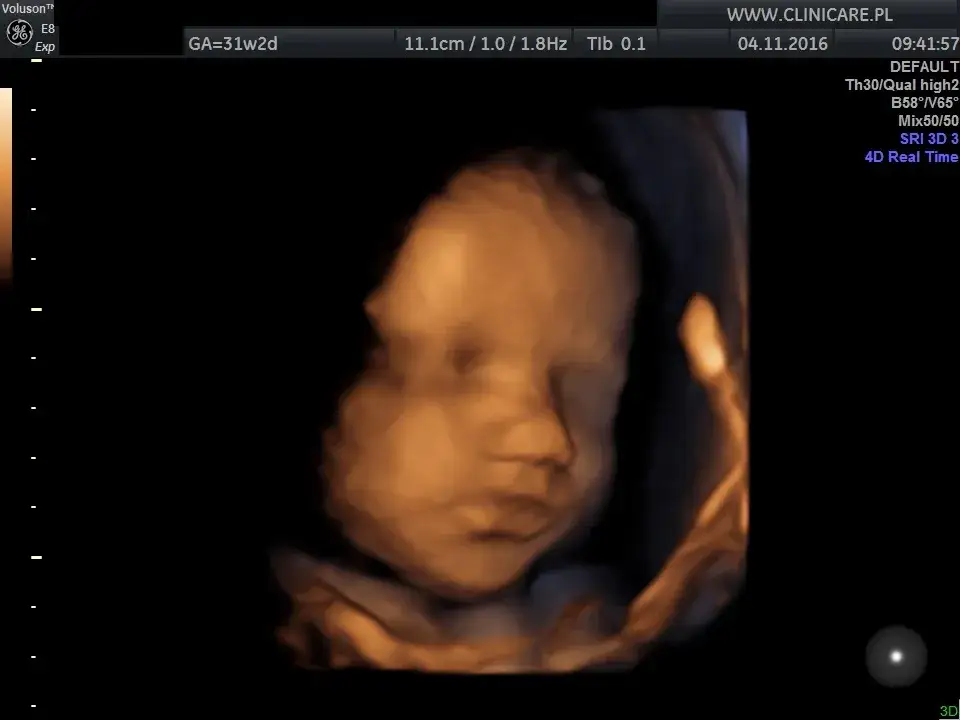 Kiedy 3. USG prenatalne? Tygodnie, co ocenia lekarz