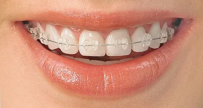 Myśli o aparacie na jeden łuk? Sprawdź, kiedy to możliwe!