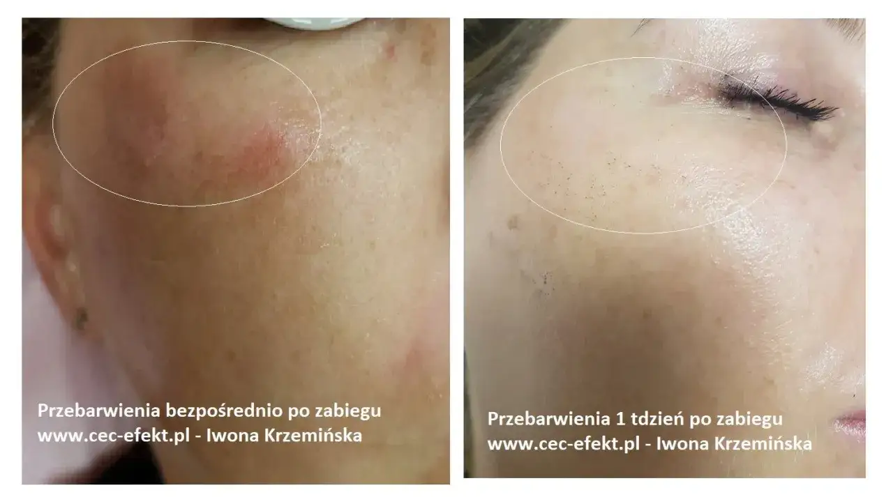 Cera naczynkowa: Pozbądź się rumienia! Pielęgnacja, zabiegi, dieta