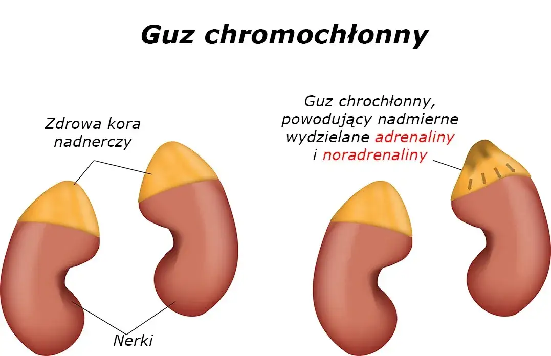 Guz nadnercza do jakiego lekarza? Kluczowe informacje o specjalistach