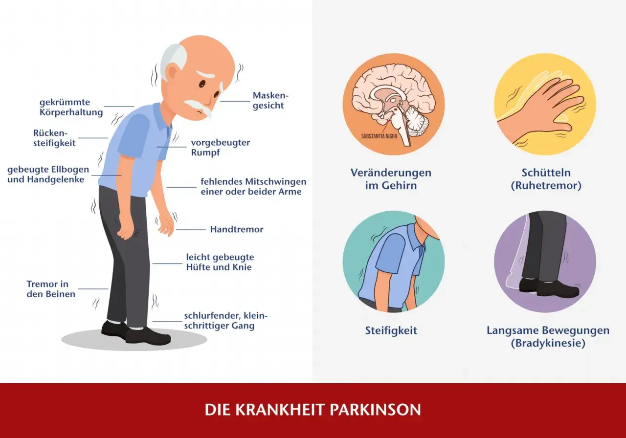 Illustration von Parkinson-Symptomen: gebeugte Haltung, Tremor, Steifigkeit, Gehirn.