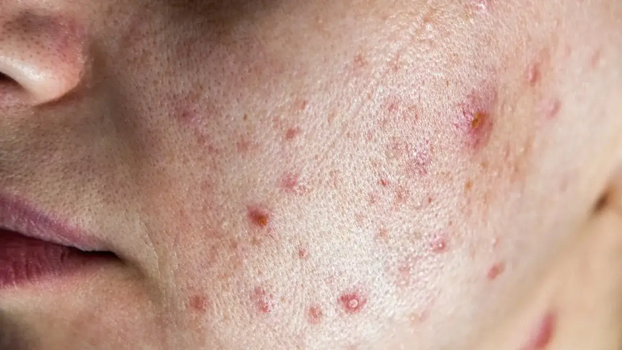 Pryszcze na brodzie: Hormony, dieta, pielęgnacja znajdź przyczynę!