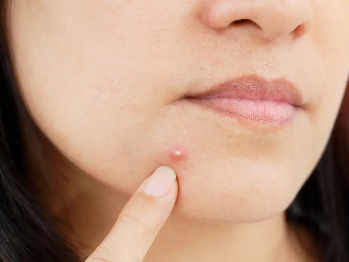 Maść ichtiolowa na pryszcze: Twoje SOS na ropne i podskórne "gule"