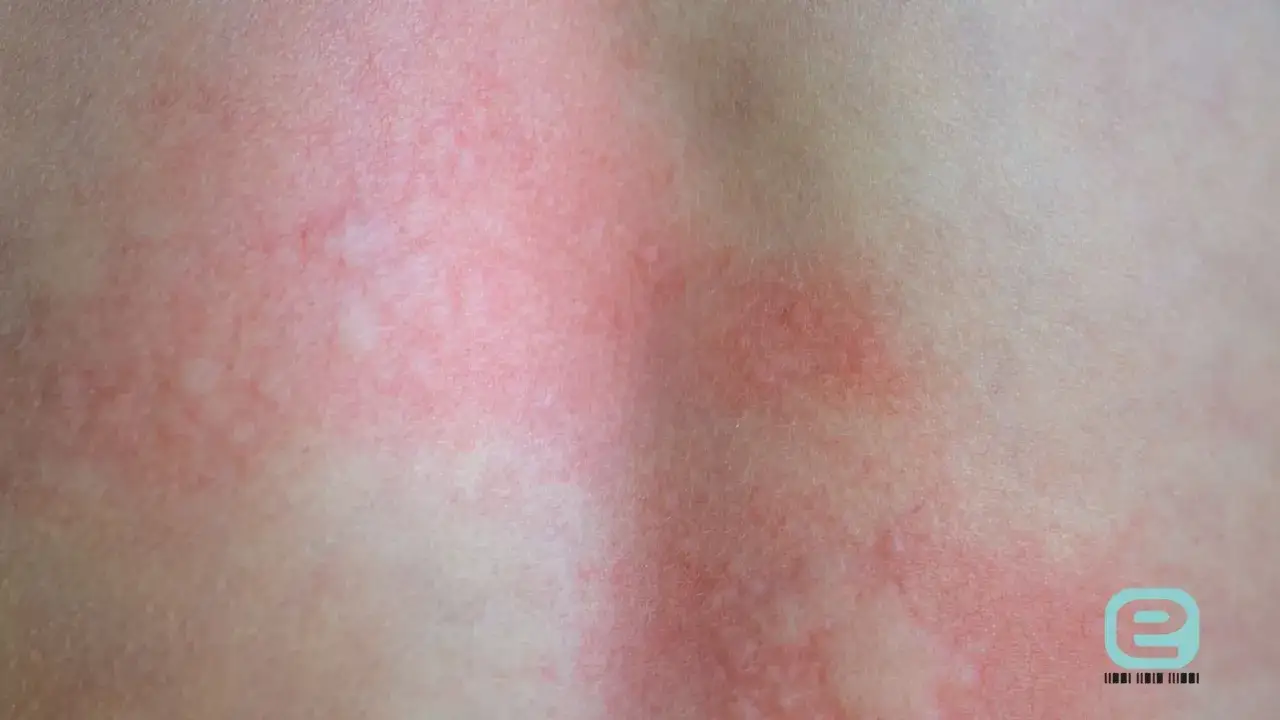 Ugryzienie kleszcza: objawy, rumień, KZM kiedy do lekarza?