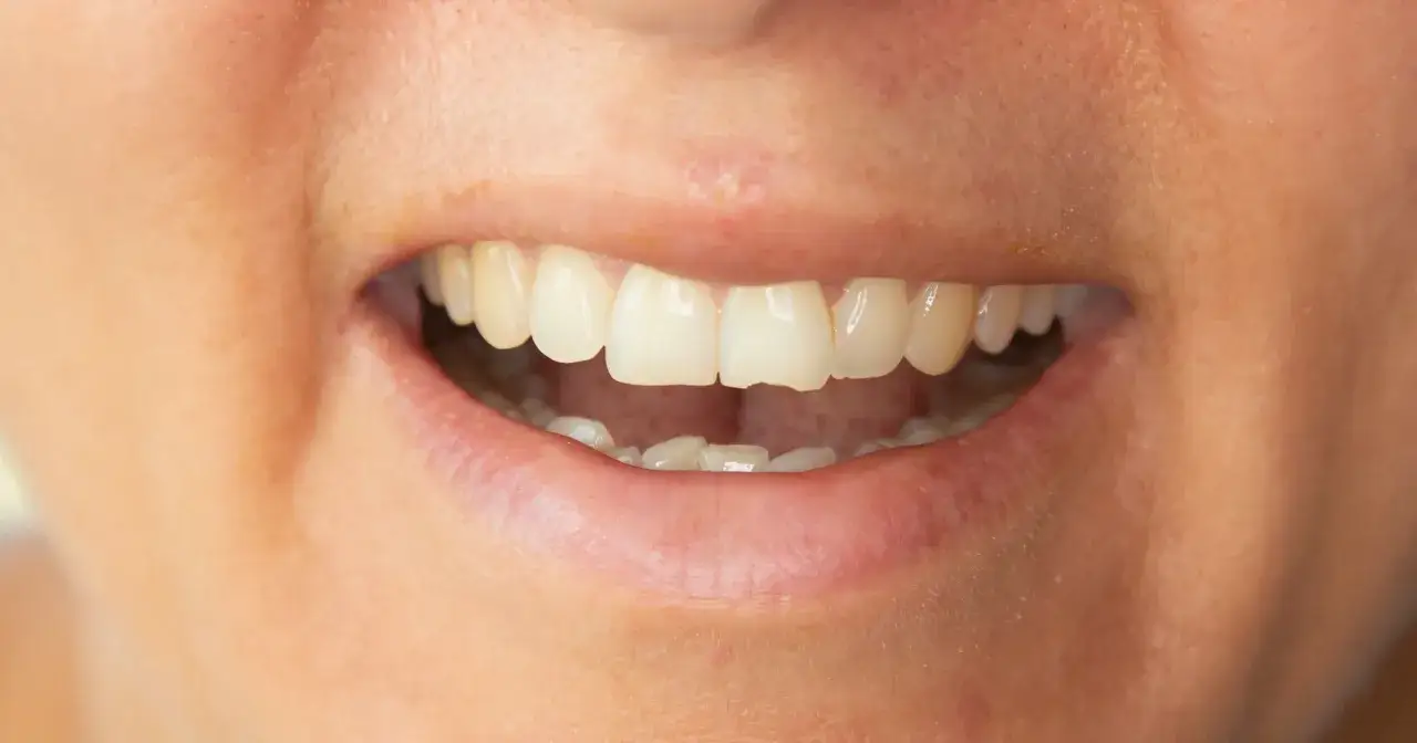 Ukruszył się ząb? Sprawdź, co robić! Leczenie, koszty, NFZ