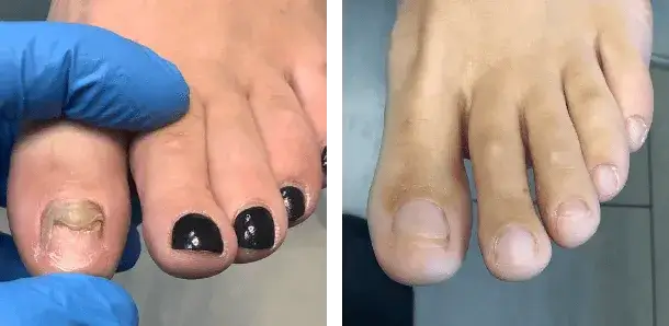 Lekarz od paznokci: Dermatolog czy podolog? Dowiedz się!