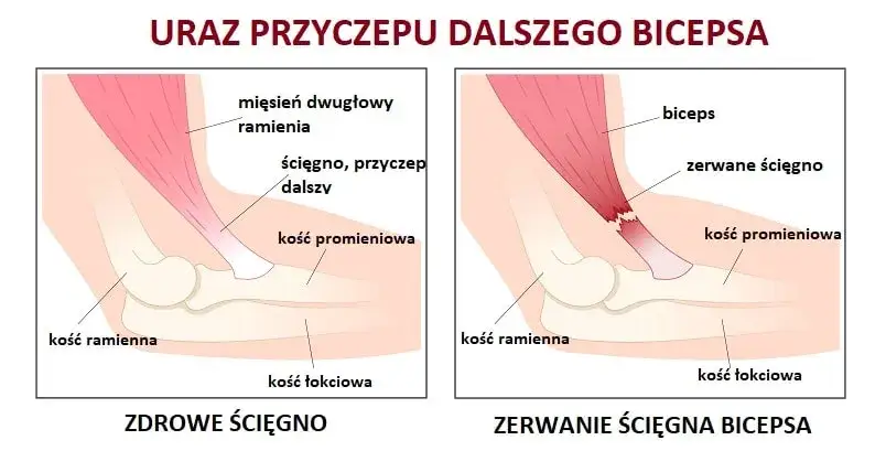 Naderwany biceps - objawy, które powinny cię zaniepokoić