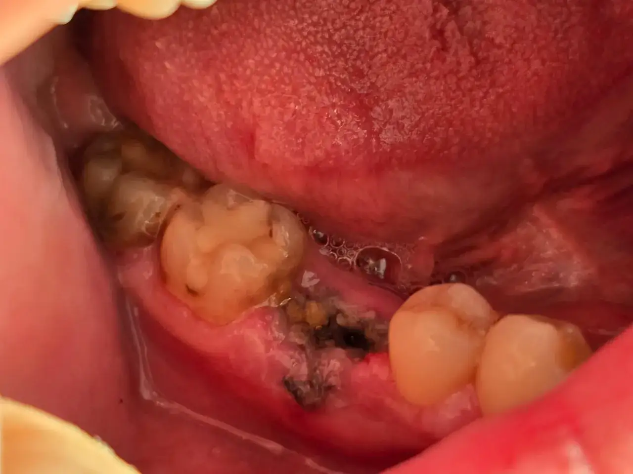 Widoczne są zęby i jama ustna, z widocznym sączeniem krwi po wyrwaniu zęba.