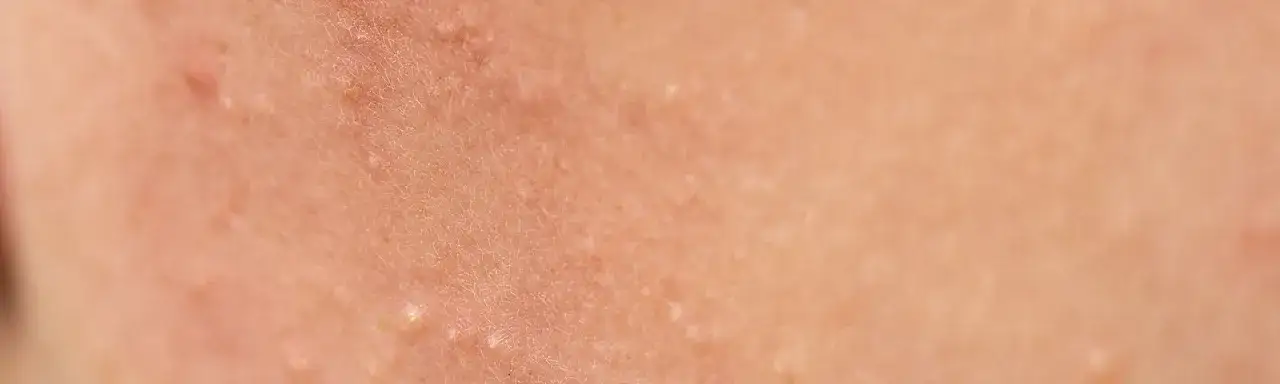 Jak wygląda zapchana cera i jak ją skutecznie wyleczyć?