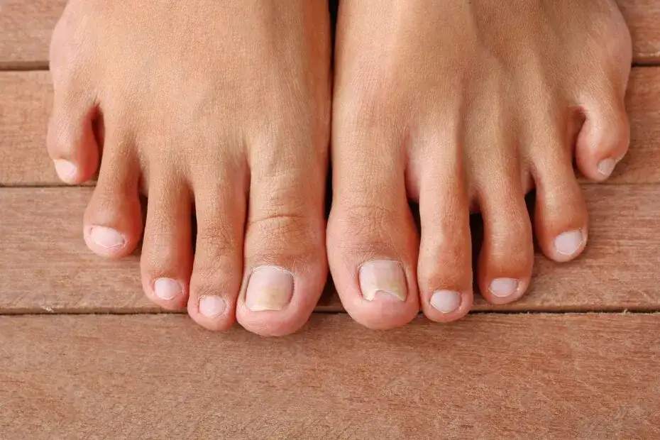 Skuteczne leki na grzybicę stóp – uniknij bólu i nawrotów