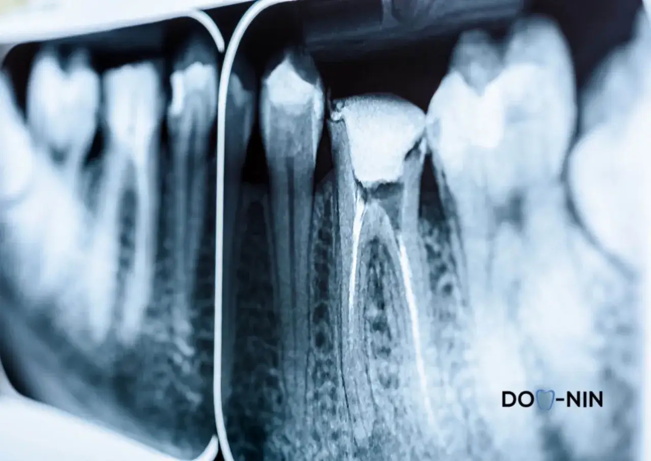 Czy torbiel zęba to nowotwór? Poznaj zagrożenia i objawy