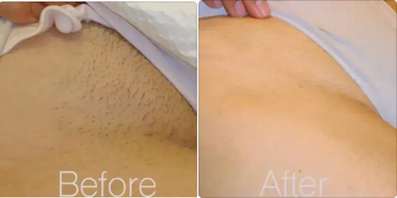 Jak złagodzić podrażnienia po depilacji okolic bikini skutecznie i szybko