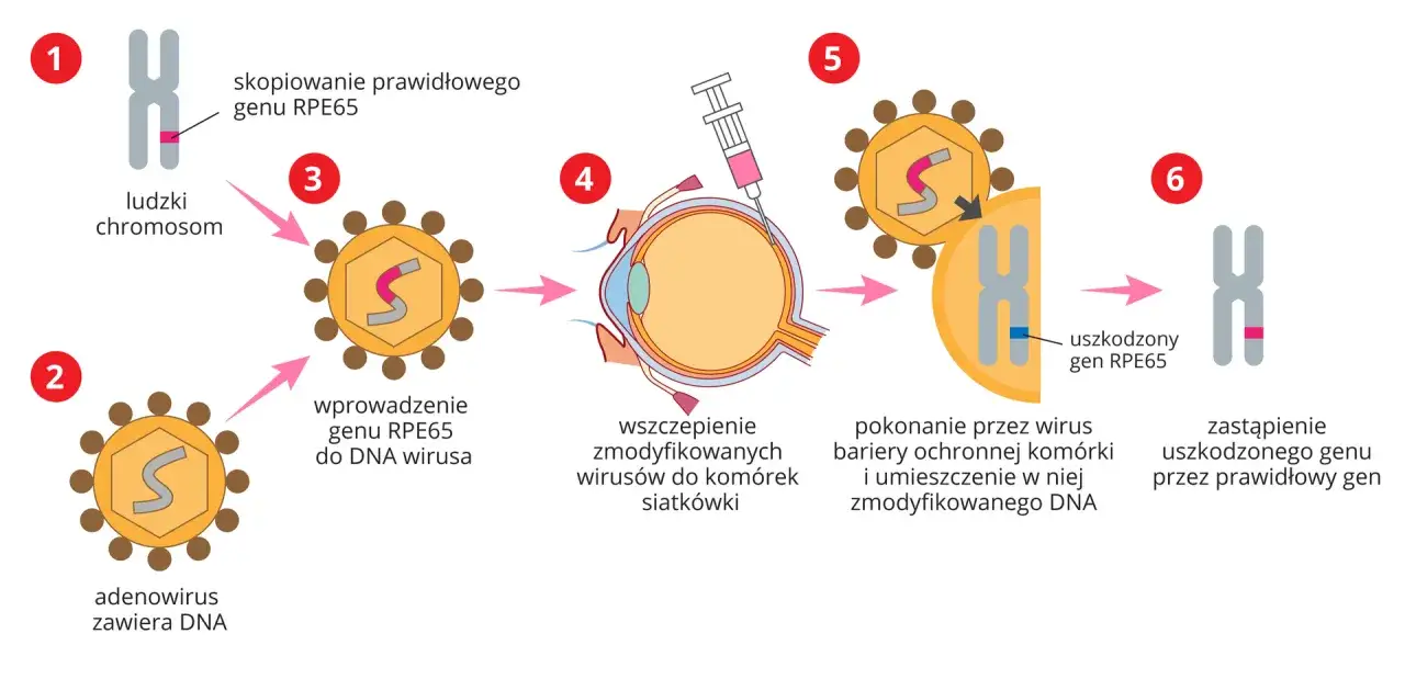 Schemat przedstawia terapię genową: wirus jako wektor biologia wprowadza prawidłowy gen RPE65 do komórek siatkówki, zastępując uszkodzony.