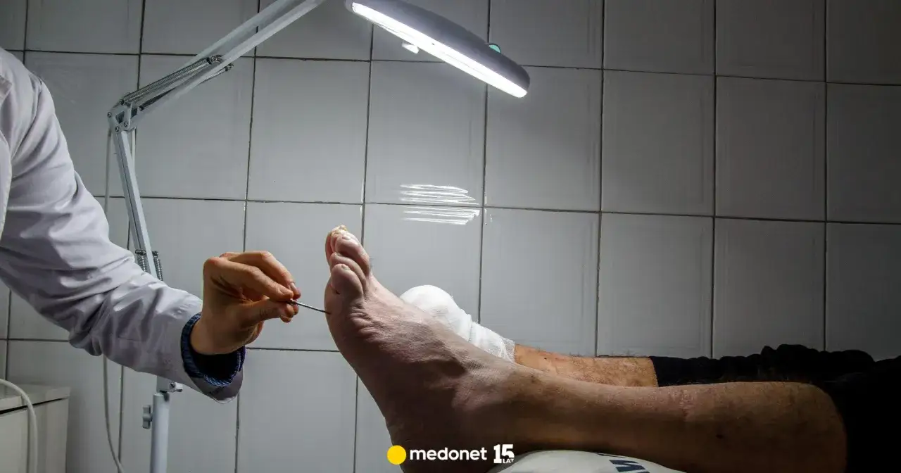 Stopa cukrzycowa: Twój plan na zdrowe stopy i uniknięcie amputacji