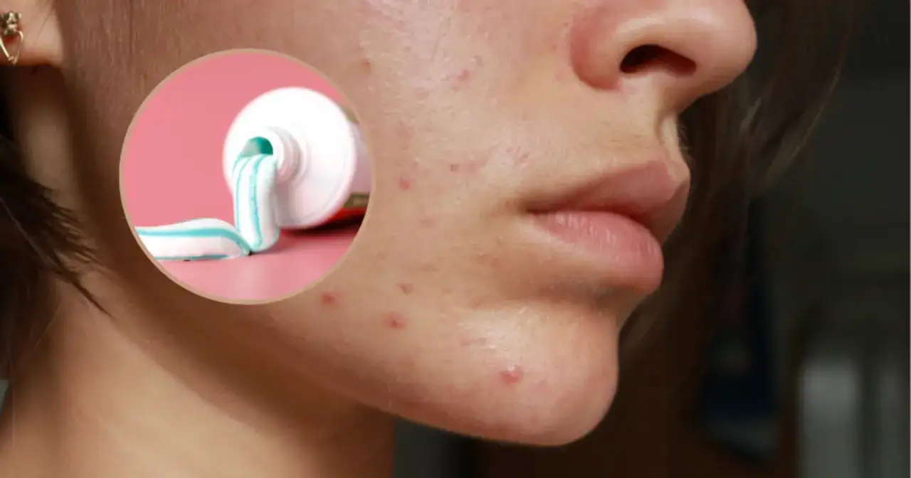 Czy pasta do zębów wysusza pryszcze? Dermatolog obala mit!