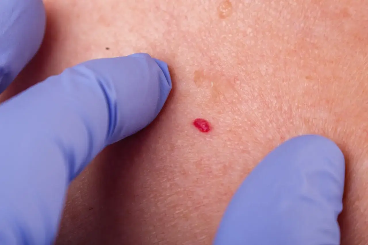 Dłoń w niebieskiej rękawiczce bada małe, czerwone znamię na skórze.