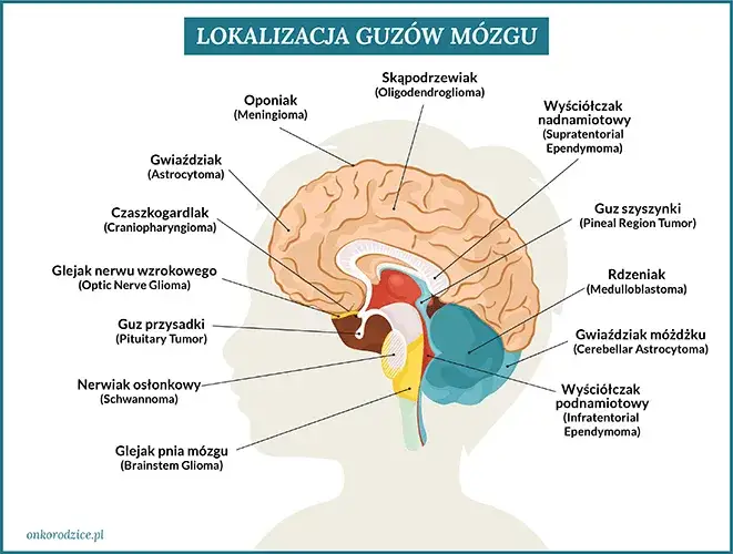 Czy to mogą być objawy guza mózgu? Zobacz, co powinieneś wiedzieć