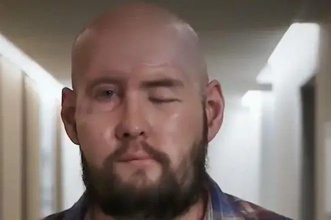 Pierwszy na świecie przeszczep twarzy - historia, która zmienia życie