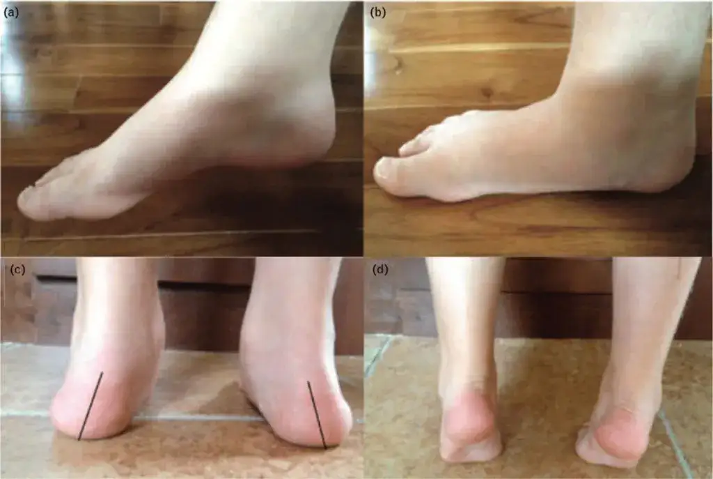 Płaskostopie u dziecka: kiedy norma, a kiedy sygnał alarmowy?