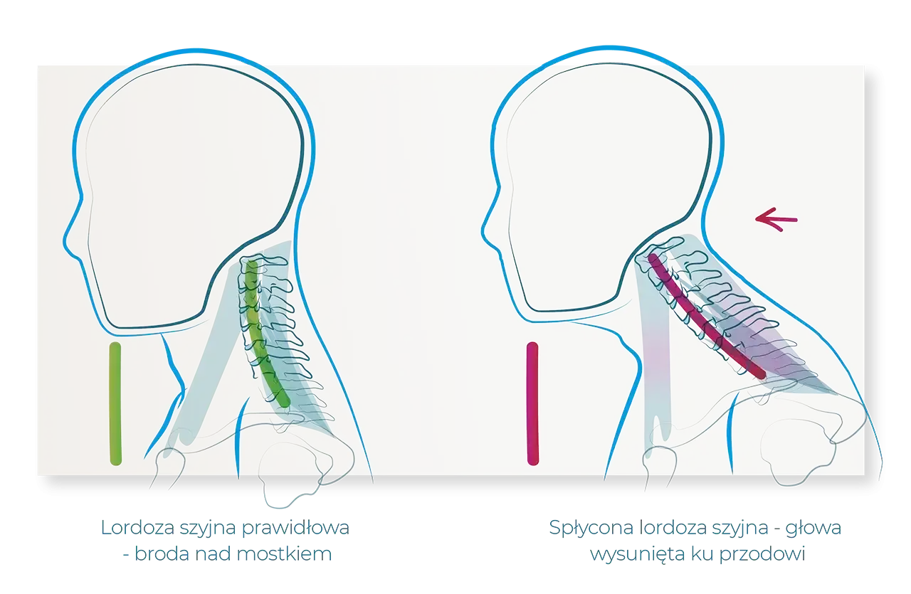 Ilustracja porównuje prawidłową lordozę szyjną z jej zniesieniem. Po prawej, zniesiona lordoza szyjna powoduje wysunięcie głowy do przodu.