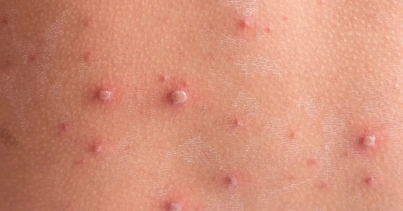 Skóra dziecka z licznymi pęcherzykami i krostkami, charakterystycznymi dla ospy. Wskazówki, jak kąpać dziecko z ospą, pomogą złagodzić swędzenie.