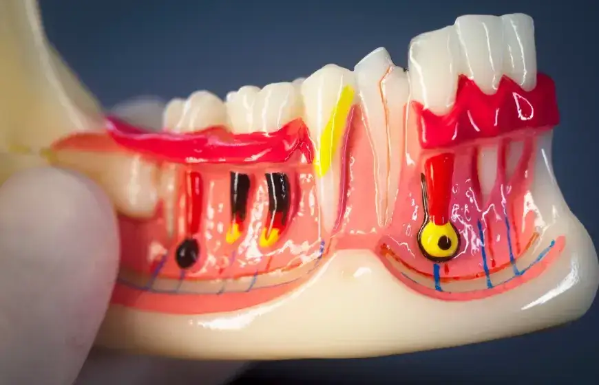 Dlaczego bolą zęby? Odkryj przyczyny i skuteczne leczenie bólu