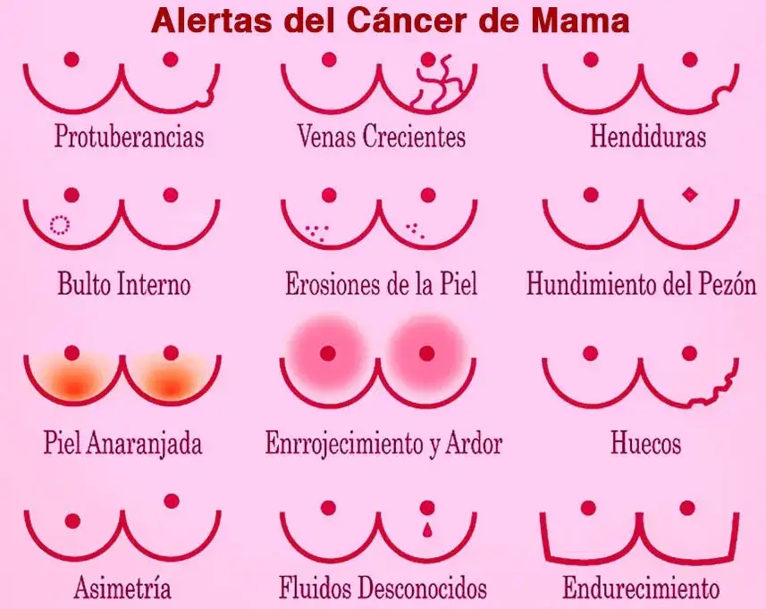 Síntomas cáncer de mama: ¿Qué señales no debes ignorar?