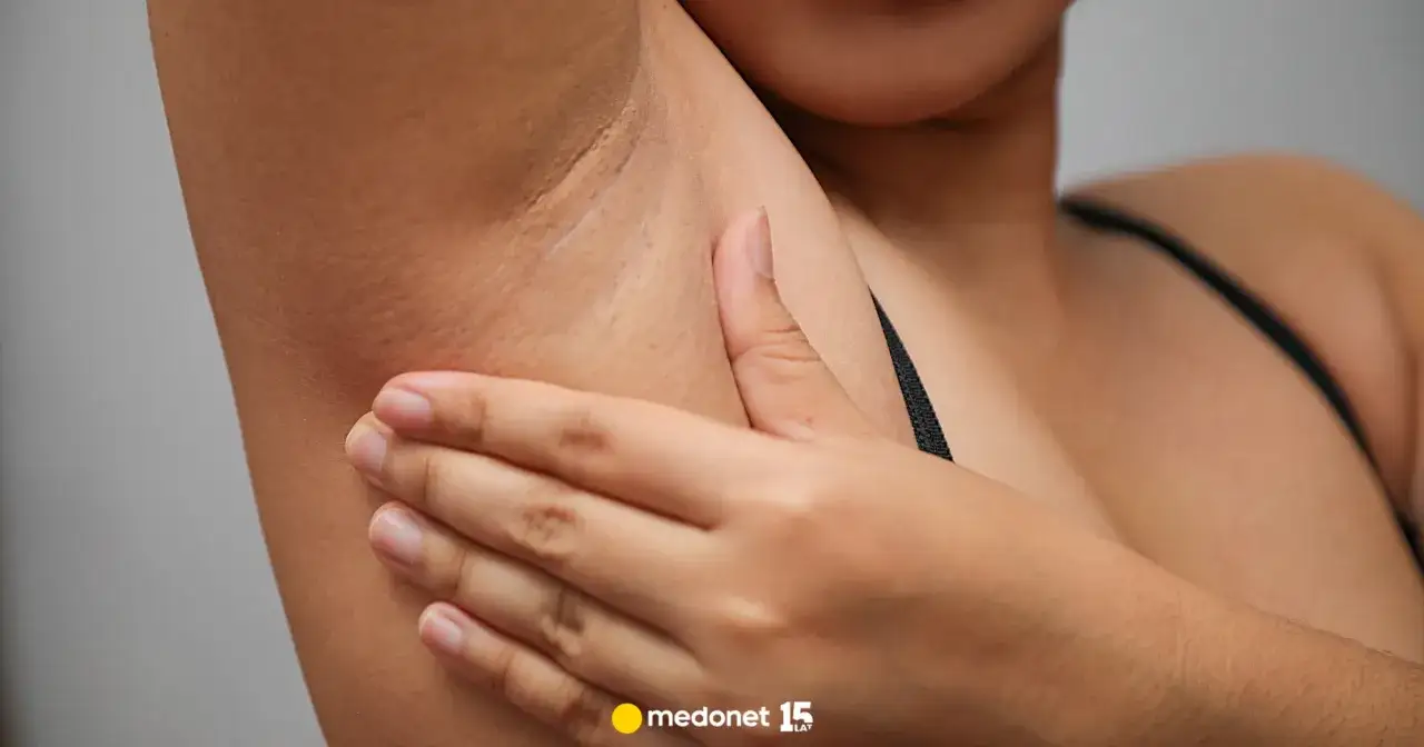 Pryszcz podskórny: Jak się go pozbyć? Skuteczne sposoby i zakazy