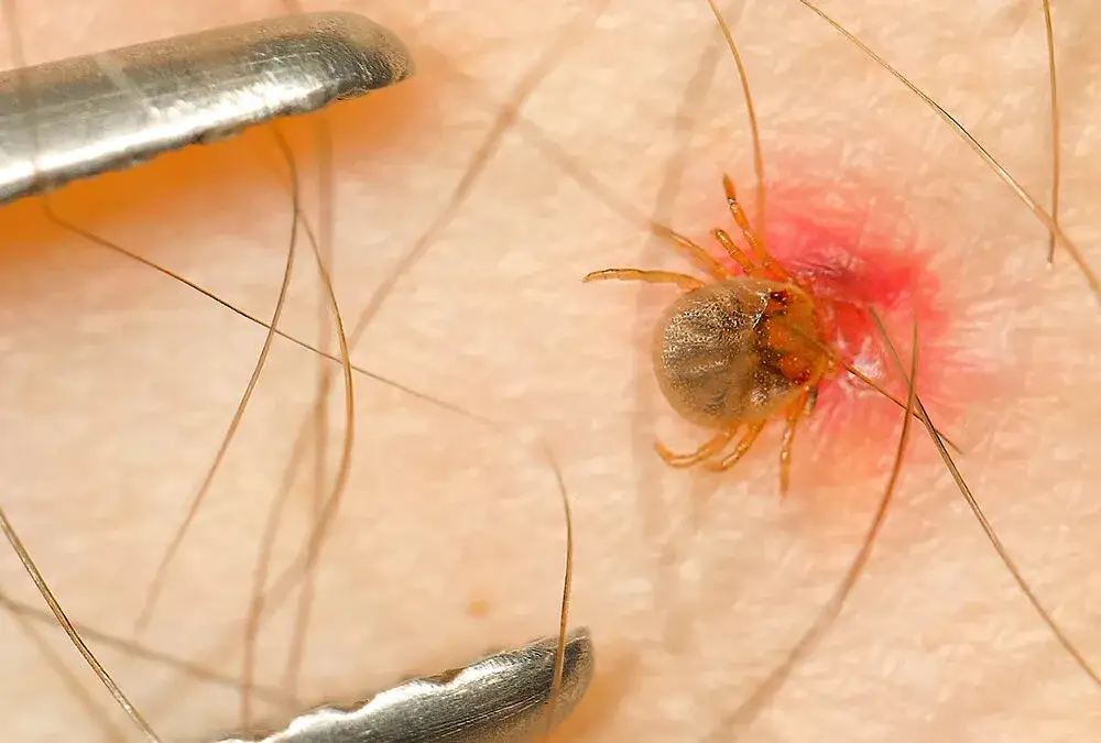 Co zrobić, jak zostanie głowa kleszcza - uniknij groźnych konsekwencji