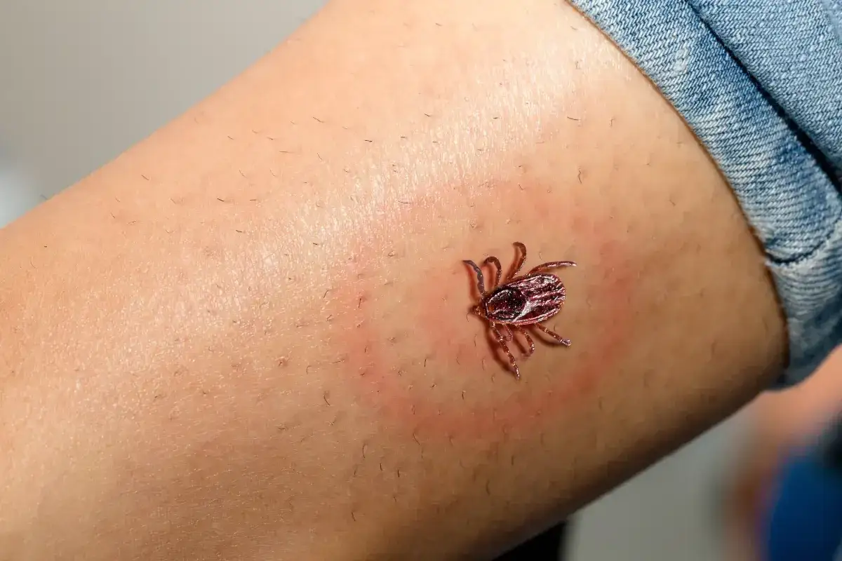 Kleszcz wbity w skórę, otoczony zaczerwienieniem.
