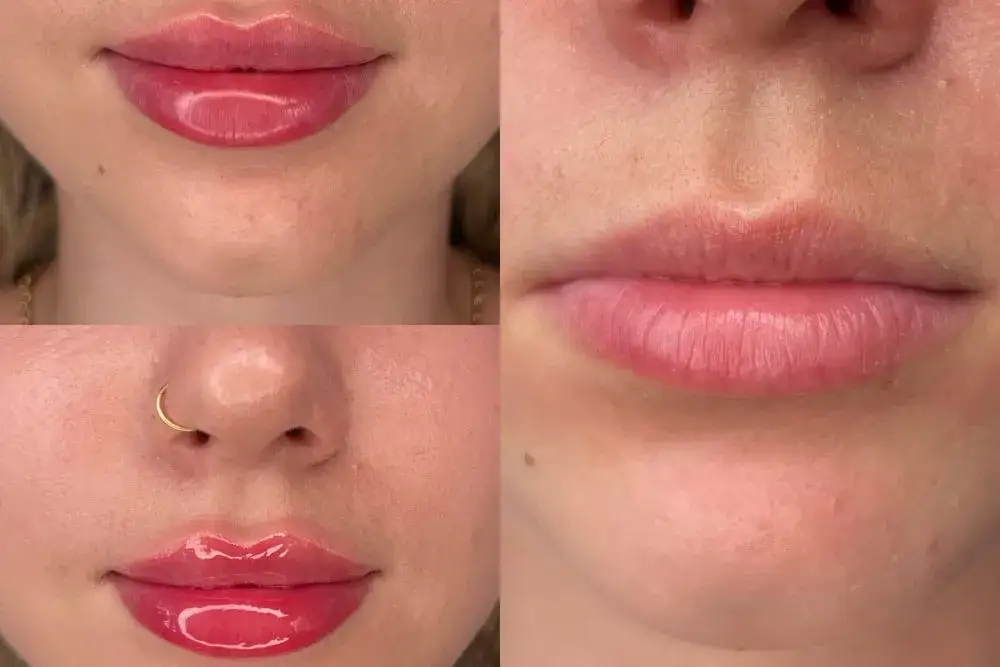 Gojenie ust po kwasie hialuronowym: Sprawdź, co Cię czeka krok po kroku