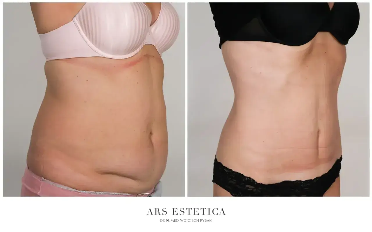 Ile kosztuje liposukcja brzucha? Pełny cennik i ukryte koszty