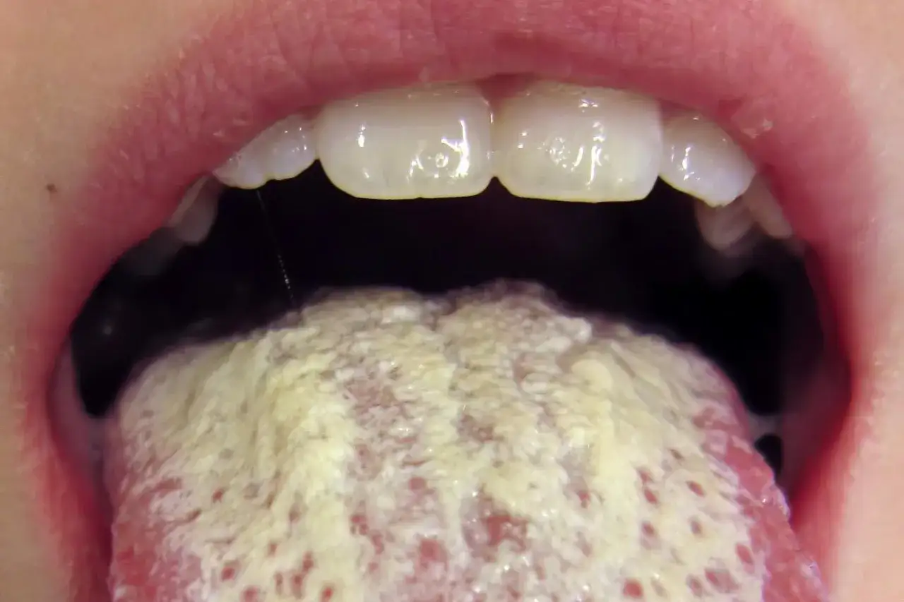 Język pokryty białym nalotem, objaw pleśniawek. Szukasz domowych sposobów na pleśniawki?