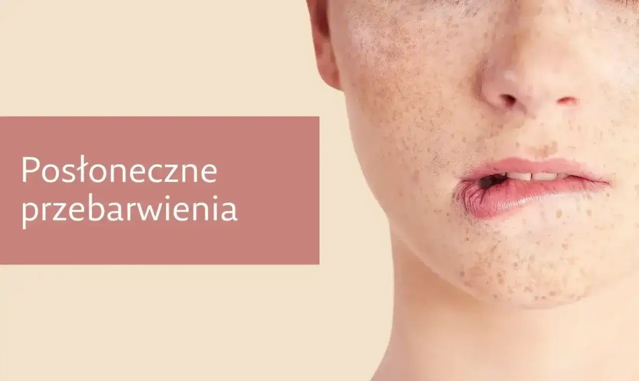 Zbliżenie na twarz z widocznymi przebarwieniami, które mogą być objawem melazmy.