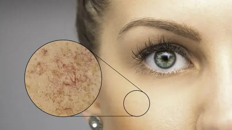 Cera naczynkowa: Jak wygląda? Rozpoznaj objawy i zacznij działać