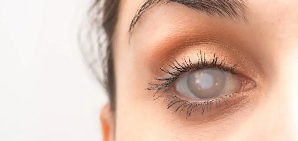 Zaćma kiedy operować drugie oko? Kluczowe informacje o terminach i ryzyku