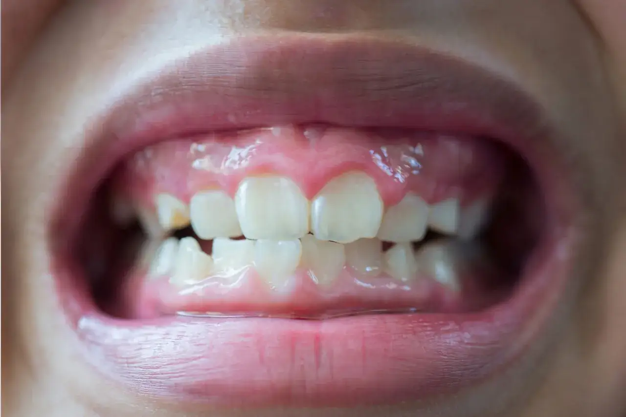 Czy to zapalenie dziąseł? Rozpoznaj objawy i działaj!