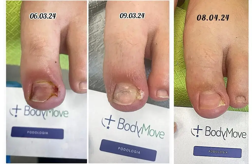 Wrastający paznokieć: Dlaczego nie wycinać samemu? Profesjonalne metody.