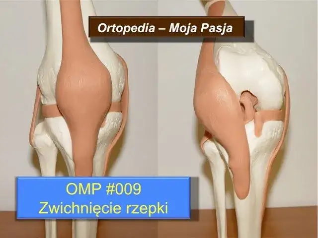 Ile trwa rehabilitacja po zwichnięciu rzepki? Poznaj prawdziwe czasy powrotu