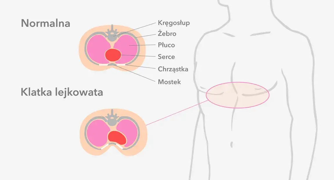 Lejkowata klatka piersiowa – jakiego lekarza potrzebujesz?