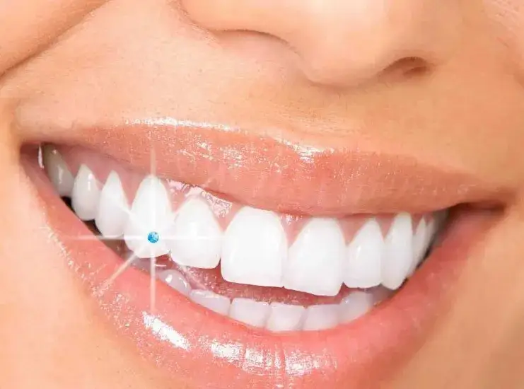 Biżuteria nazębna jak zrobić: krok po kroku do pięknego uśmiechu