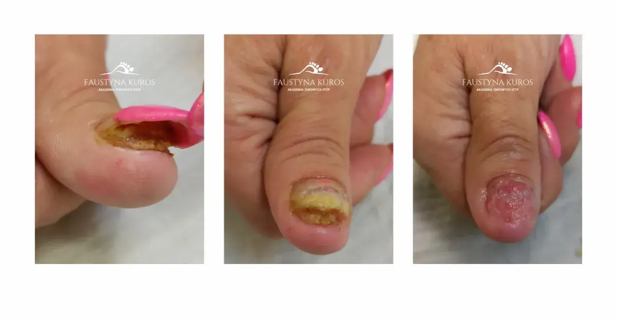 Palec bez paznokcia: Gojenie, odrost i pierwsza pomoc krok po kroku.