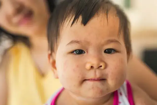 Mononukleoza zakaźna u dzieci: rozpoznaj pierwsze niepokojące objawy